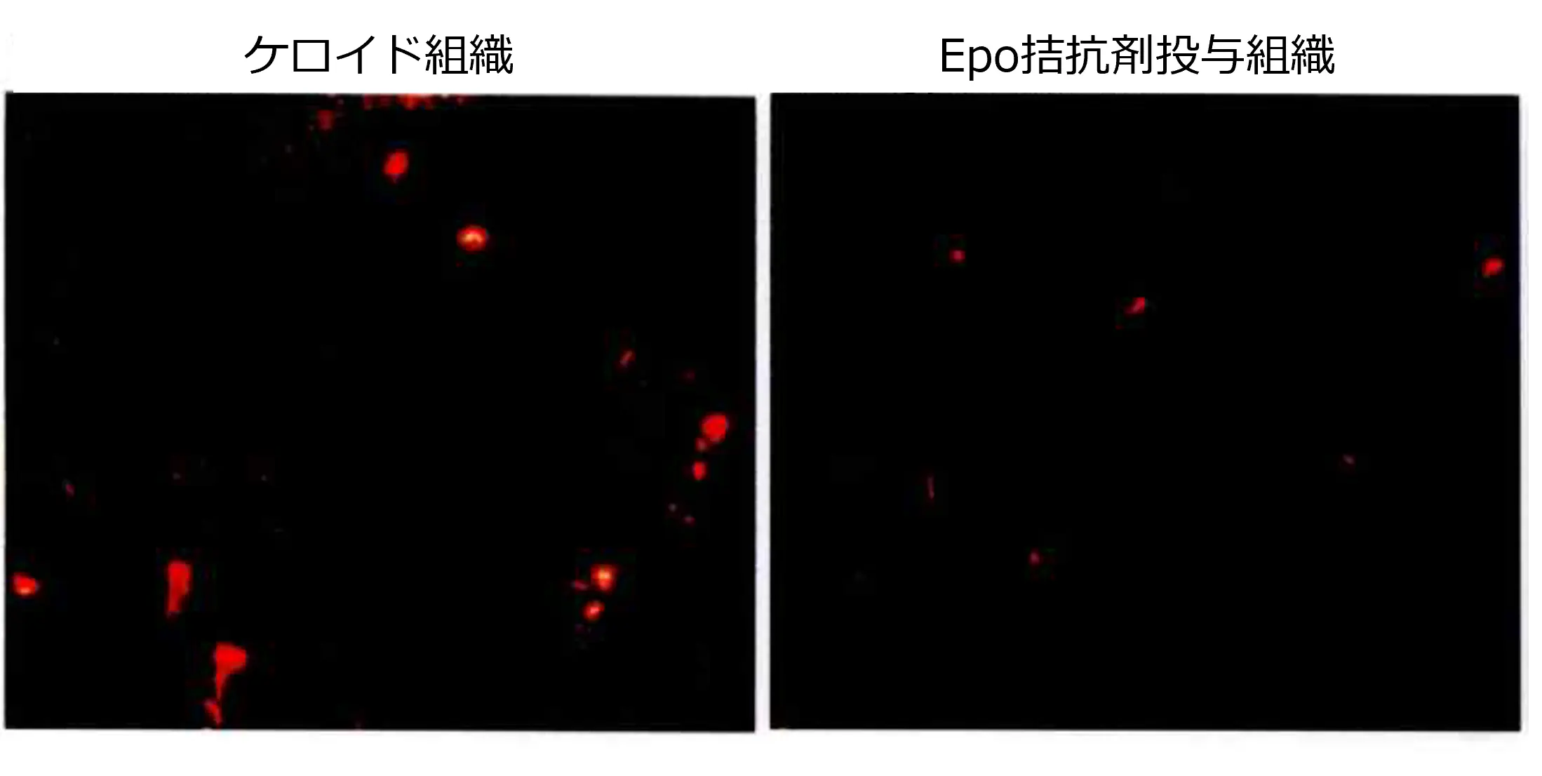 ケロイド組織に発現する肥満細胞を染色